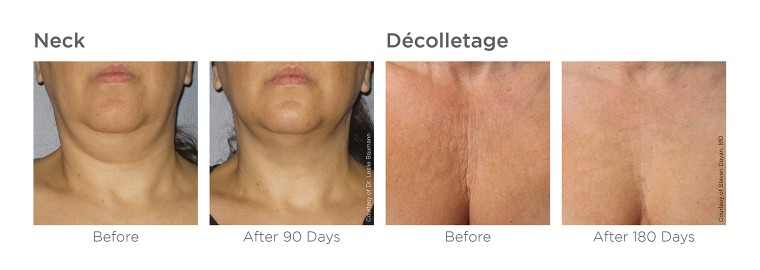 Ultherapy_image