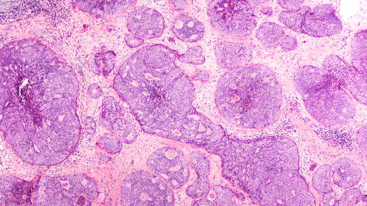 Ductal carcinoma in situ shown in a breast cancer biopsy